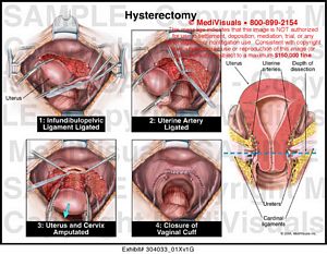 hysterectomy medivisuals1 medical