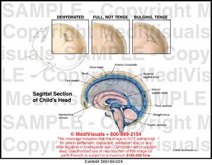 Medivisuals States of the Anterior Fontanelle Medical Illustration