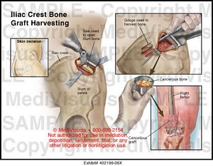 Iliac Crest Bone Graft Harvesting Medical Exhibit Medivisuals