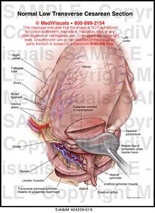 Medivisuals Normal Low Transverse Cesarean Section Medical Illustration