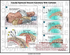 Caudal epidural steroid injection with catheter cpt