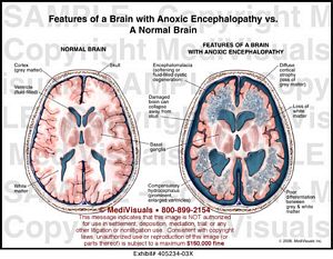 Features Of A Brain With Anoxic Encephalopathy Vs. A Normal Brain