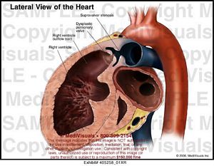 Lateral View of the Heart Medical Illustration Medivisuals