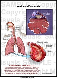 Aspiration Pneumonia Medical Illustration Medivisuals