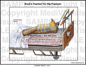 Buck's Traction for Hip Fracture Medical Illustration Medivisuals