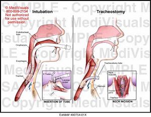 Intubation vs. Tracheostomy Medical Exhibit Medivisuals