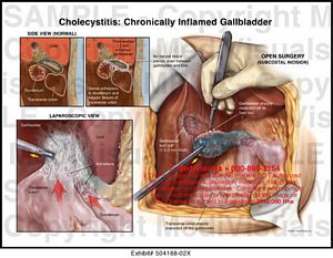 gallbladder cholecystitis inflamed 02x chronically poland medivisuals1