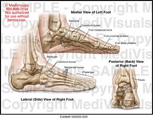 Medial View of Left Foot Medical Exhibit