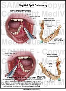 Medivisuals Sagittal Split Osteotomy Medical Illustration