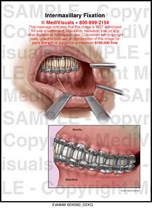 Intermaxillary Fixation Medical Exhibit Medivisuals