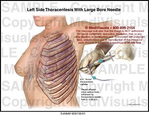 Left Side Thoracentesis with Large Bore Needle Medical Exhibit