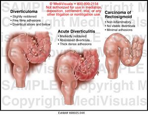 Diverticulitis Medical Illustration MediVisuals