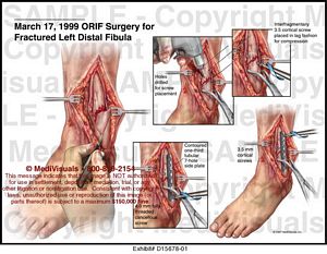 surgery orif fibula distal left fractured fusion ankle medivisuals1