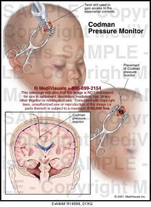 Codman Pressure Monitor Medical Illustration MediVisuals