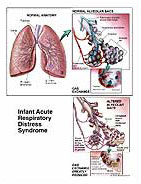 Infant Acute Respiratory Distress Syndrome Medical Exhibit Medivisuals