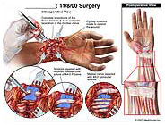 Diastasis Recti Medical Illustration Medivisuals