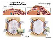 Medivisuals Surgery To Repair Large Ventral Hernia Medical Illustration