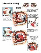 Medivisuals Strabismus Surgery Medical Illustration