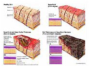 Burn Medical Illustration Exhibits - MediVisuals