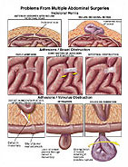 Diastasis Recti Medical Illustration Medivisuals