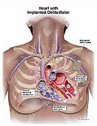 Heart With Implanted Defibrillator Medical Illustration Medivisuals