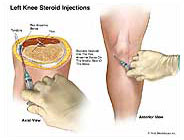 steroid knee injections