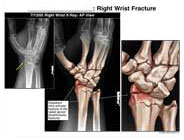 Medivisuals Right Wrist Fracture Medical Illustration