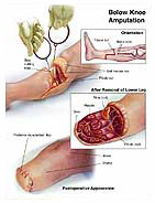 Below Knee Amputation Medical Illustration Medivisuals