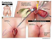 Medivisuals Proctectomy Medical Illustration