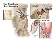 Bone Graft Harvesting Procedure - Medical and Trial Exhibits