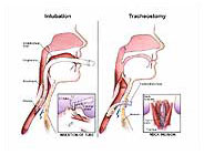 tracheostomy vs cricothyrotomy