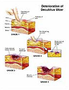 Decubitus Ulcer Medical Exhibits