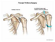 the large, flat, triangular bone that overlies the posterior thoracic wall is called the: