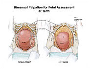 Bimanual Palpation For Fetal Assessment At Term Medivisuals