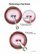 Medivisuals Performing A Pap Smear Medical Illustration