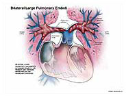 massive pulmonary embolism