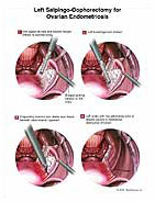 Ooforoplastia e salpingectomia laparoscópica / Oophoroplasty and  laparoscopic salpingectomy (left). 