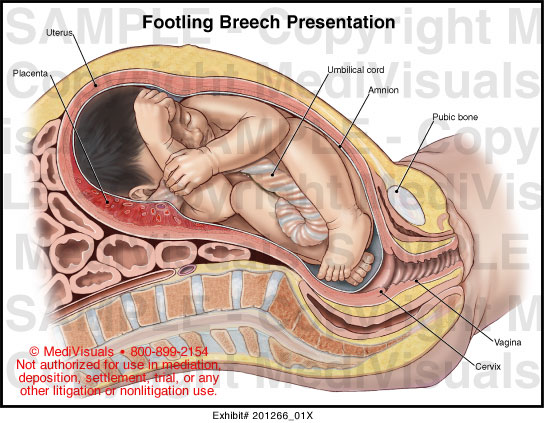 Footling breech online