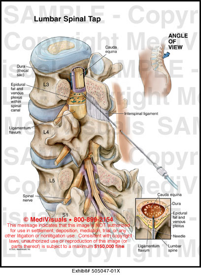 Lumbar Spinal Tap Medical Illustration